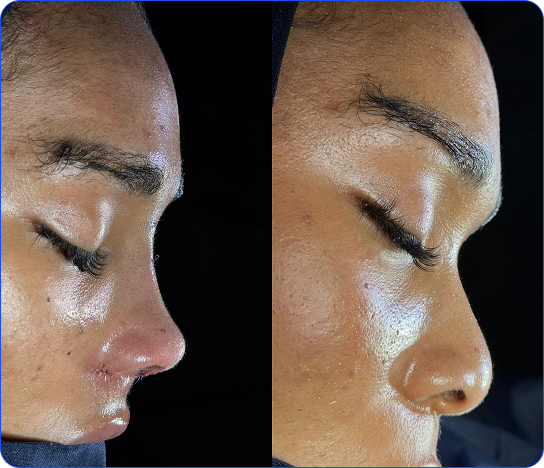 Revision Rhinoplasty Correction