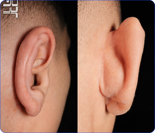 Otoplasty Ear Reshaping
