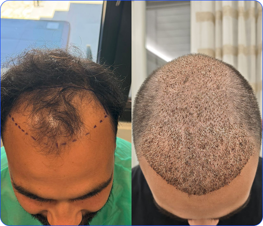 Hair Transplant Restoration